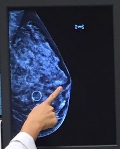 3d mammogram