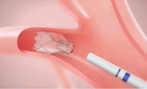 Endobronchial Valve implanted in diseased lung.