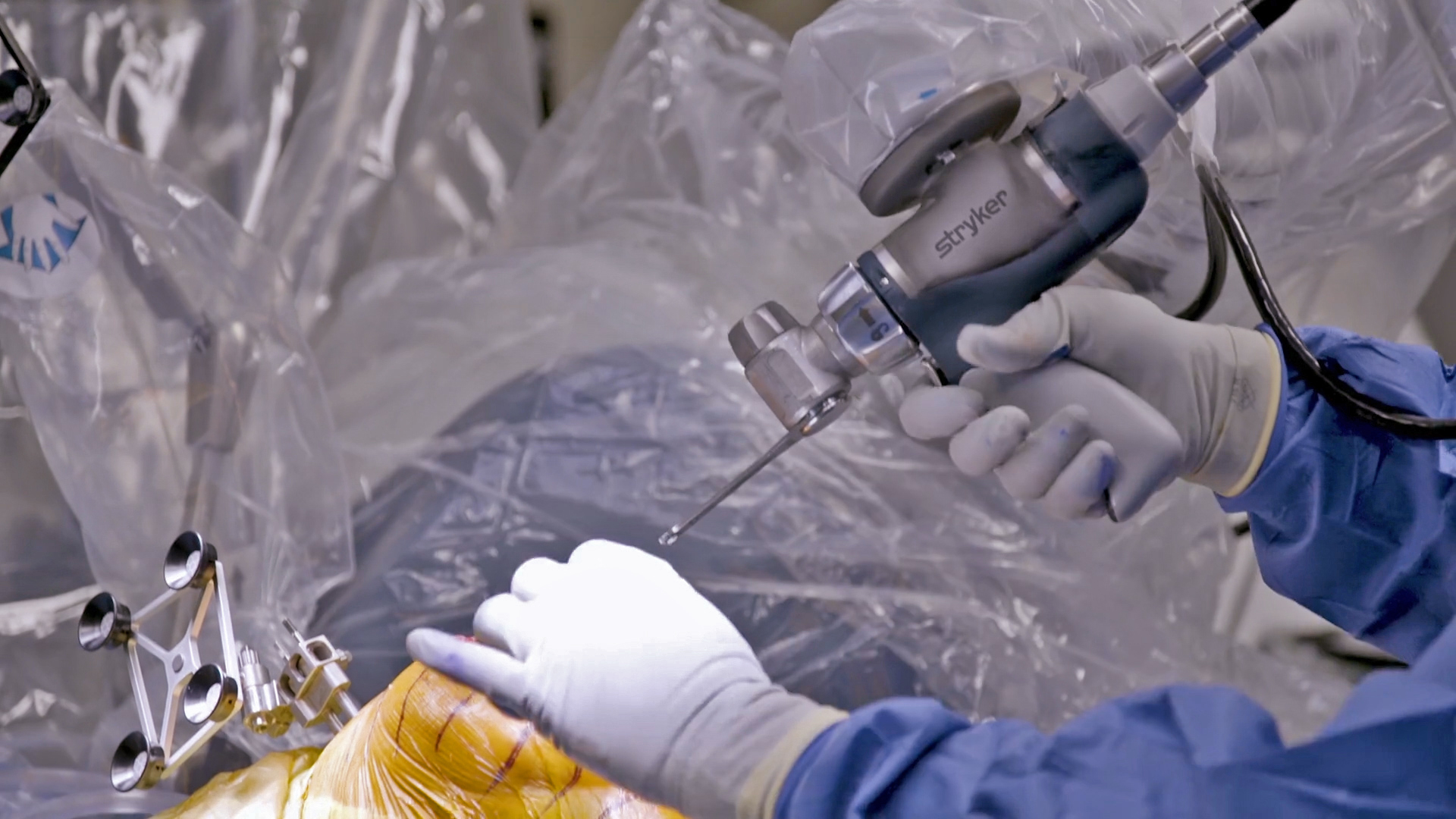 new-robotic-arm-tech-for-knee-replacements-offers-more-precision